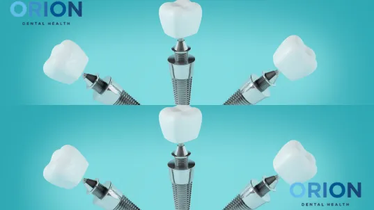 all on six dental implants