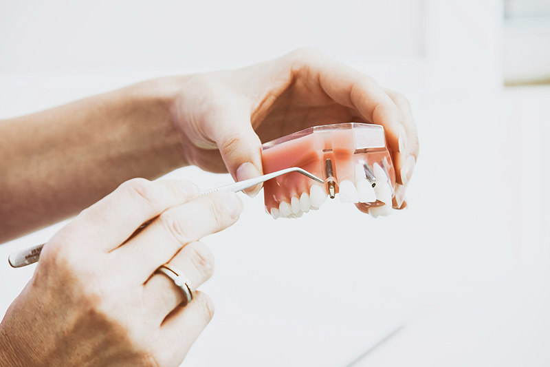 Dental Implant Treatment