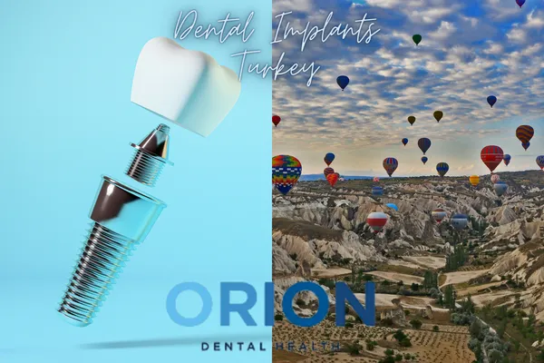 Dental implants in Antalya, Turkey