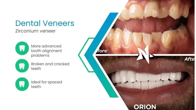 Difference between laminates and veneers in dentistry