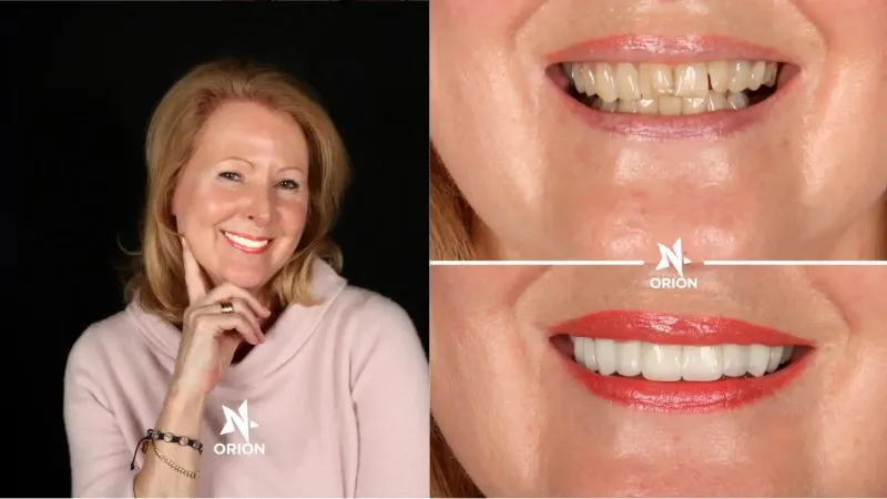 Emax veneers pros and cons