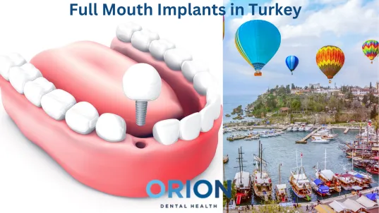 Full mouth implants in turkey