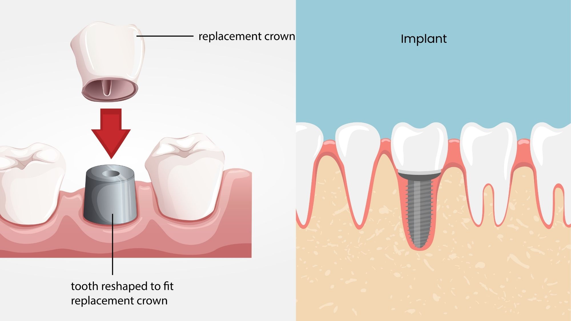 Implants or crowns