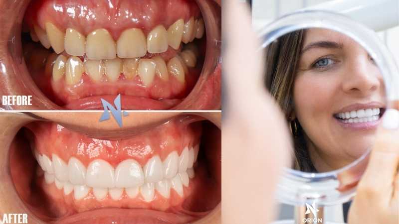 Is laser teeth whitening safe