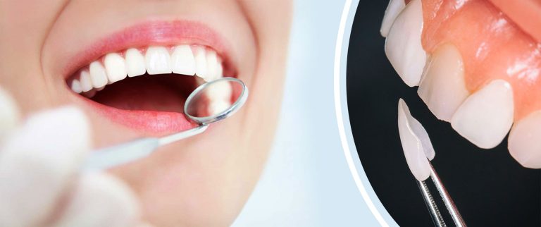laminate dental veneers