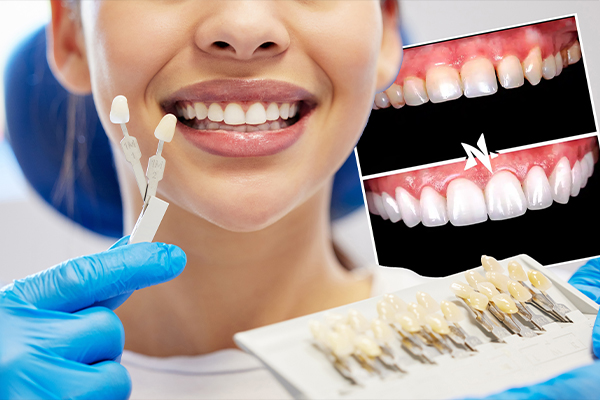 Implants or crowns