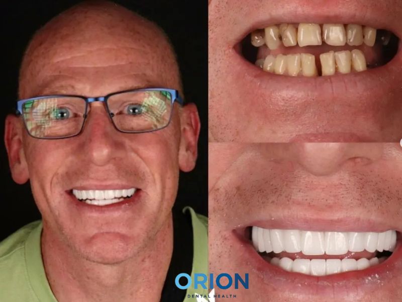 porcelain veneers Turkey