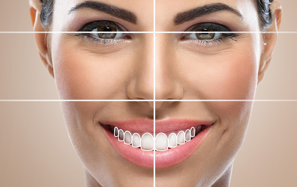 Veneers in Turkey