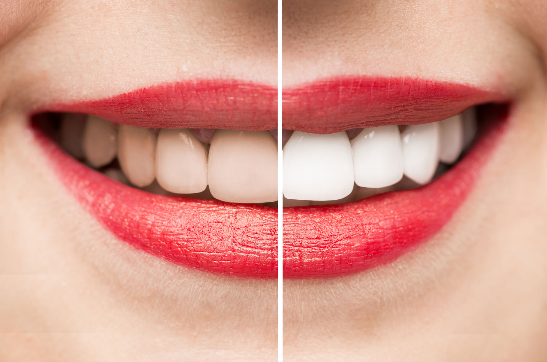 Teeth Whitening