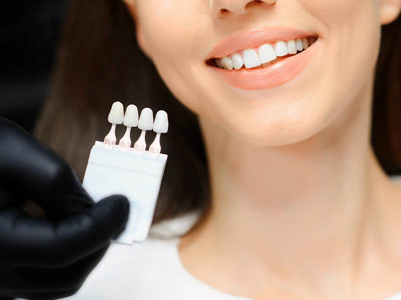Hollywood Smile