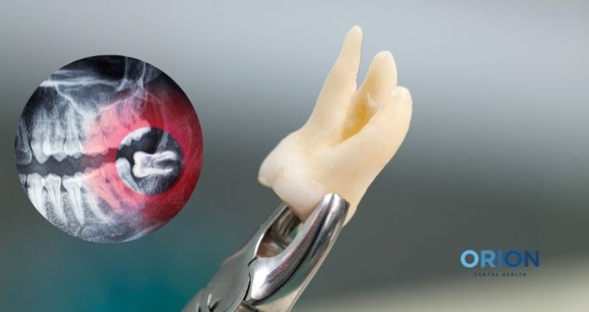 wisdom-tooth-removal-Antalya