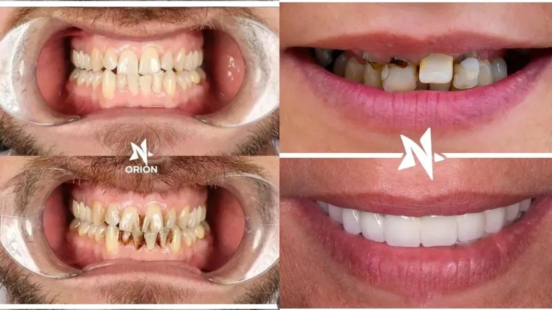 Zirconia veneers Turkey Antalya