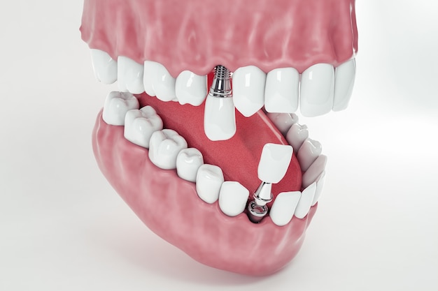 FULL MOUTH IMPLANT