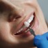 Dentist whiting teeth - teeth whitening treatment turkey